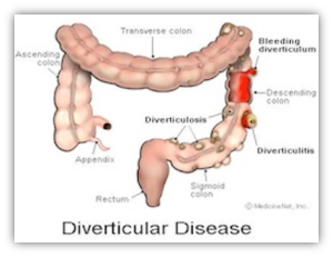 Diverticolosi