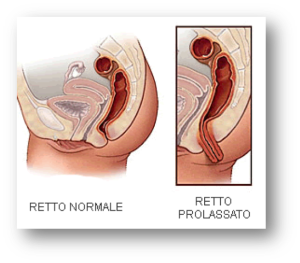 Prolasso rettale